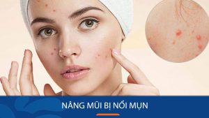 Nâng mũi bị nổi mụn: Nguyên nhân và cách xử lý hiệu quả