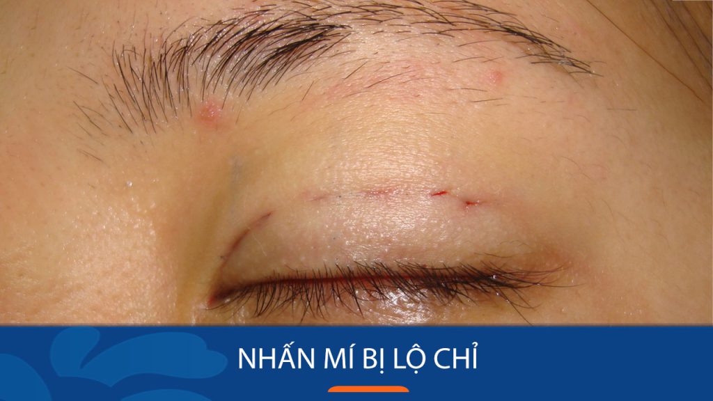 Nhấn Mí Bị Lộ Chỉ: Cách khắc phục nhanh chóng