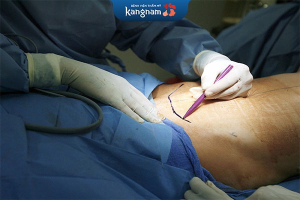 phẫu thuật căng da bụng nội soi