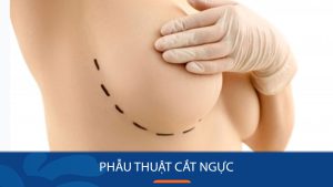 Phẫu thuật cắt ngực chuyển giới: Hành trình lột xác để sống đúng bản thân