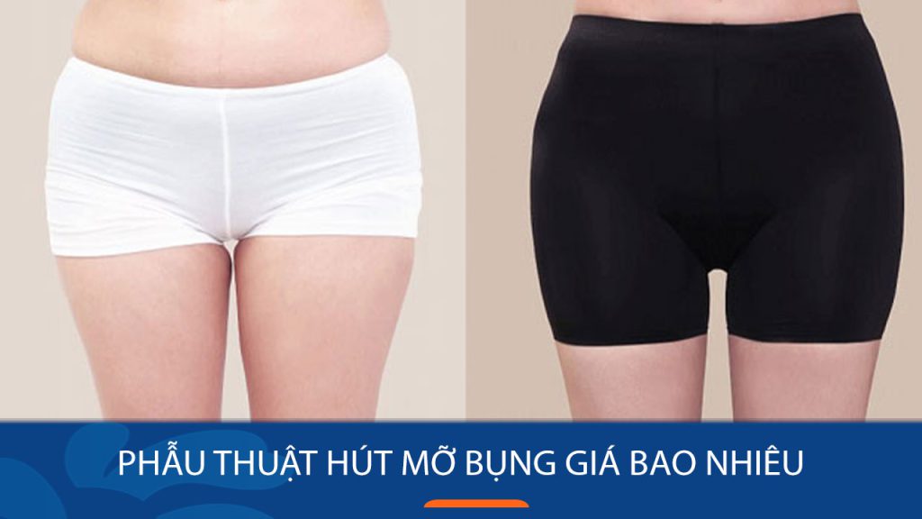 Bảng Giá Dịch Vụ Hút Mỡ Bụng Chi Tiết Mới Nhất