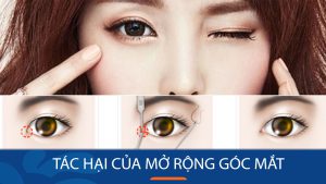 Tác hại của mở rộng góc mắt phổ biến: cách mở rộng góc mắt an toàn