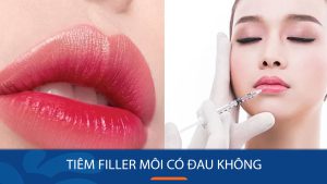 Tiêm filler môi có đau không? Bí quyết giảm đau hiệu quả khi tiêm filler môi