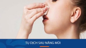 Tụ dịch sau nâng mũi: 4 Cách xử lý được bác sĩ Kangnam khuyến cáo
