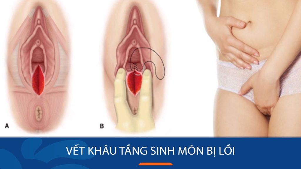 Vết khâu tầng sinh môn bị lồi: Nguyên nhân, triệu chứng và cách xử lý