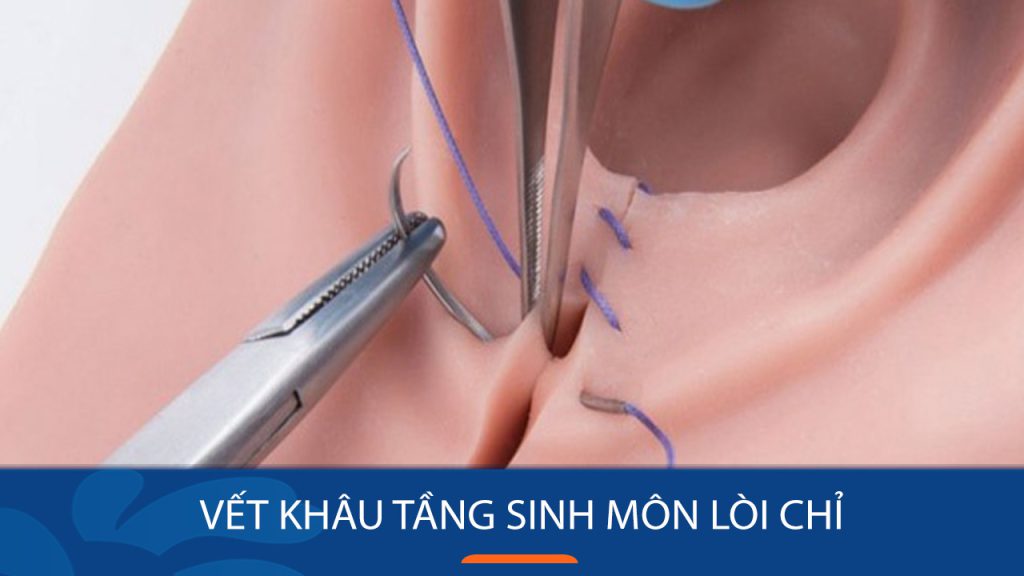 Vết khâu tầng sinh môn lòi chỉ sau sinh: Nguyên nhân, cách chăm sóc và khi nào cần đi khám?