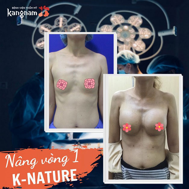 Sở hữu vòng 1 săn chắc quyến rũ, hồi phục nhanh sau 1 tháng nâng ngực K-nature 4D