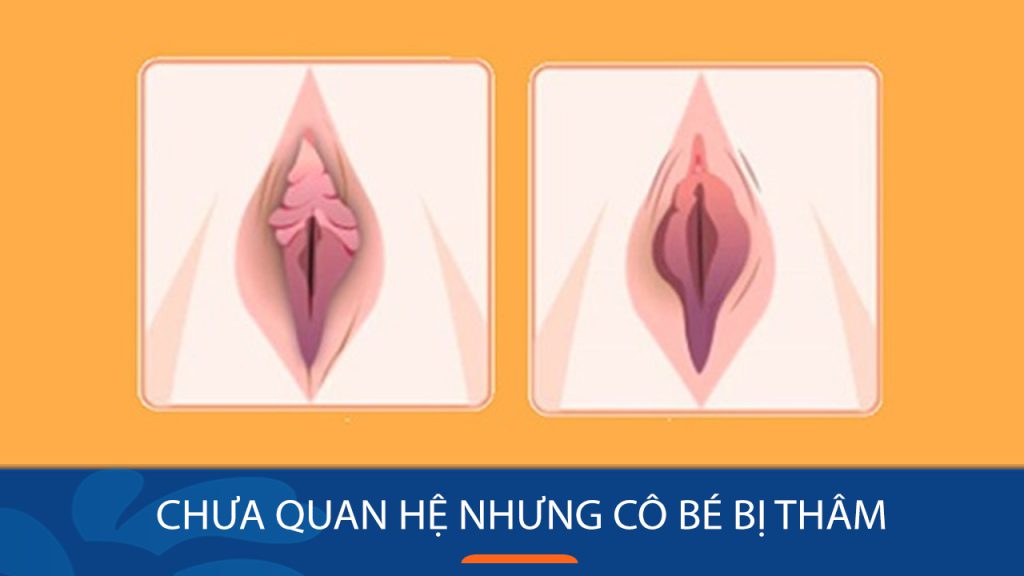 Chưa quan hệ nhưng vùng kín bị thâm: Nguyên nhân và bí quyết cải thiện