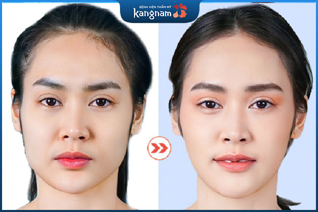 Trước và sau khi khách hàng gọt hàm tại Kangnam