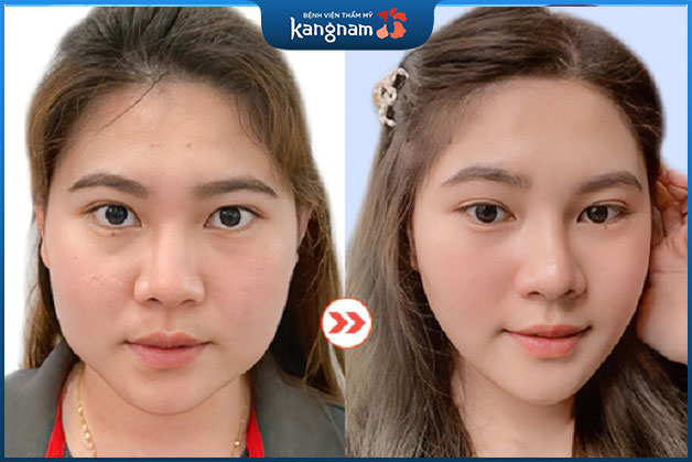Kết quả khách hàng gọt hàm đẹp và gọn hơn sau khi phẫu thuật gọt hàm tại Kangnam