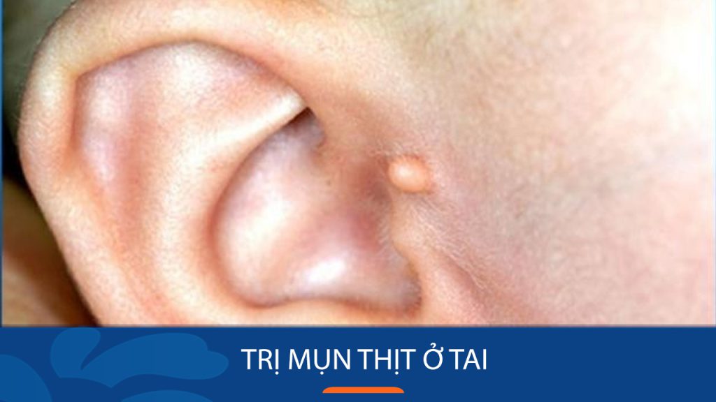 4 Cách trị mụn thịt ở tai: An Toàn, Hiệu quả nhanh nhất