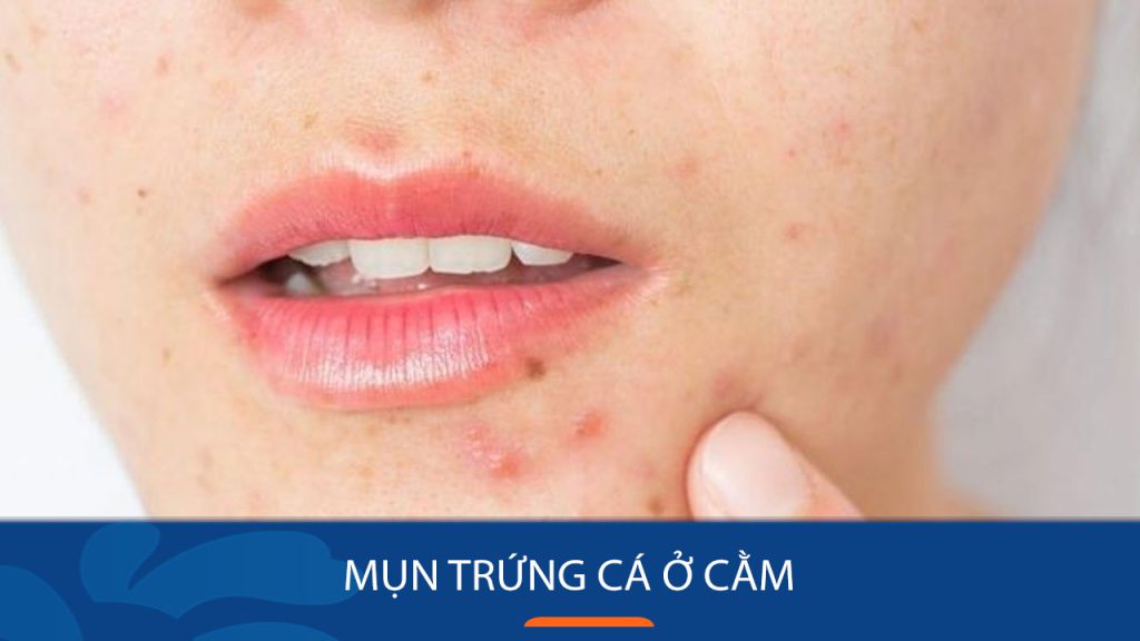 Mụn trứng cá ở cằm: Bí quyết loại bỏ mụn trứng cá ở cằm dứt điểm
