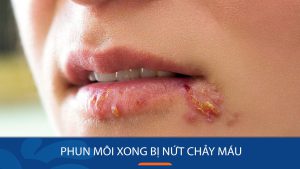 Phun môi xong bị nứt chảy máu: Mẹo khắc phục nhanh