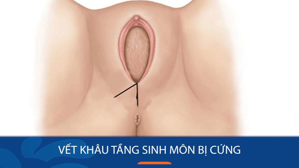 Vết khâu tầng sinh môn bị cứng: Nguyên nhân, mức độ nguy hiểm và cách xử lý hiệu quả