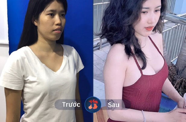 Cô nàng lột xác sau nâng ngực