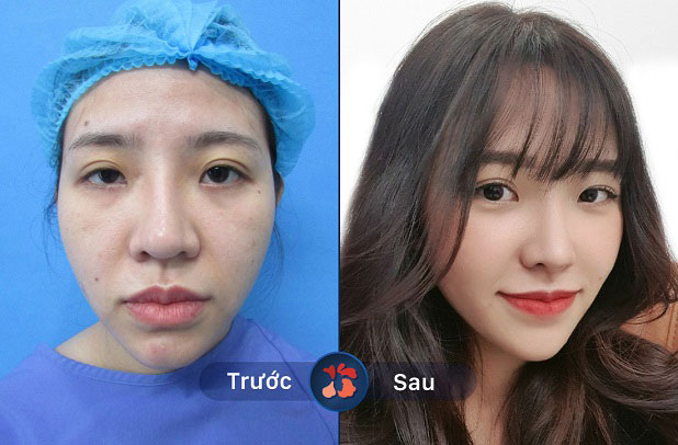 Trước và sau khi khách hàng nâng mũi 