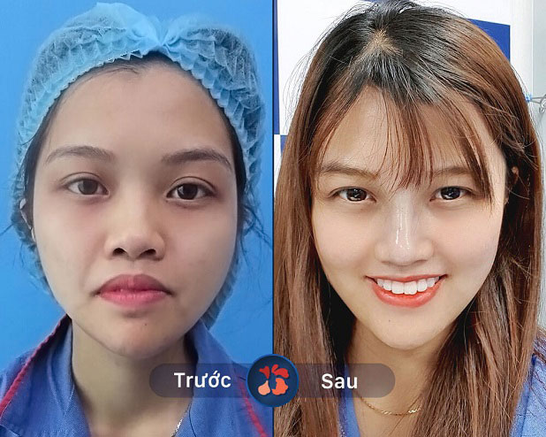 Chị Hà Thu Hường (1995, Đà Nẵng) sở hữu mũi L line chuẩn Hàn, gương mặt thon gọn với nhan sắc trẻ trung không tì vết.