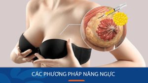 Các phương pháp nâng ngực Đẹp, An toàn, Hiện đại nhất