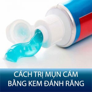 4 Cách trị mụn cám bằng kem đánh răng hiệu quả, an toàn