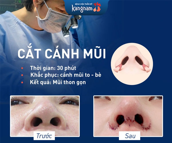 cắt cánh mũi