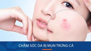 Chăm sóc da bị mụn trứng cá  – Đánh bay mụn trứng cá chỉ trong 7 ngày