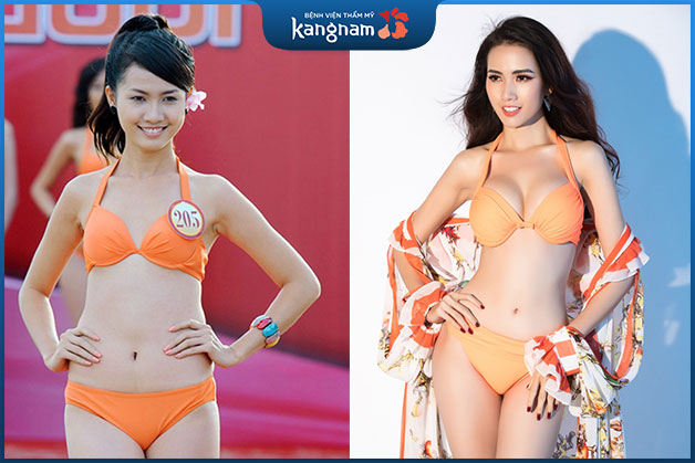 Nâng ngực chuẩn đẹp tại Kangnam