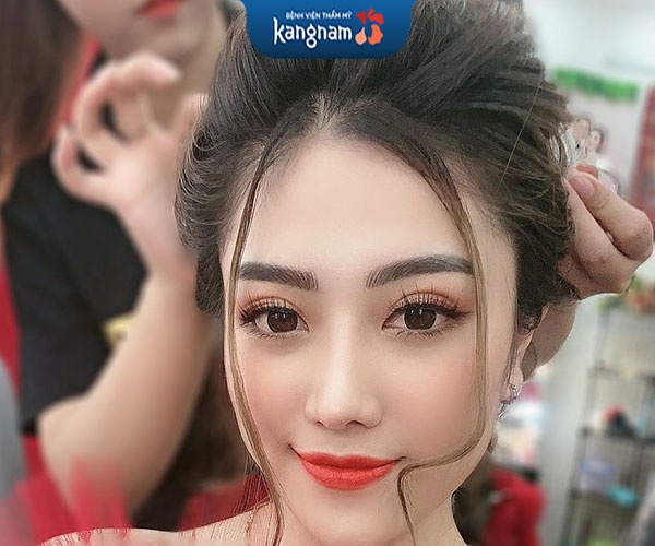 kết quả phun môi xí muội 