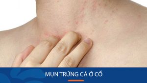 Cách loại bỏ mụn trứng cá ở cổ nhanh chóng và hiệu quả