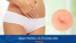 Mụn trứng cá ở vùng kín: Nguyên nhân, triệu chứng và cách điều trị