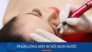 Phun Lông Mày Bị Nổi Mụn Nước: Nên Làm Gì? Cách xử lý