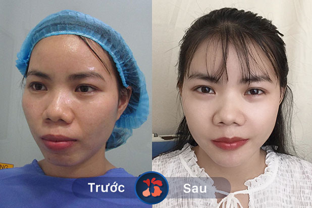 Kết quả trước và sau khi khách hàng phẫu thuật hàm hô