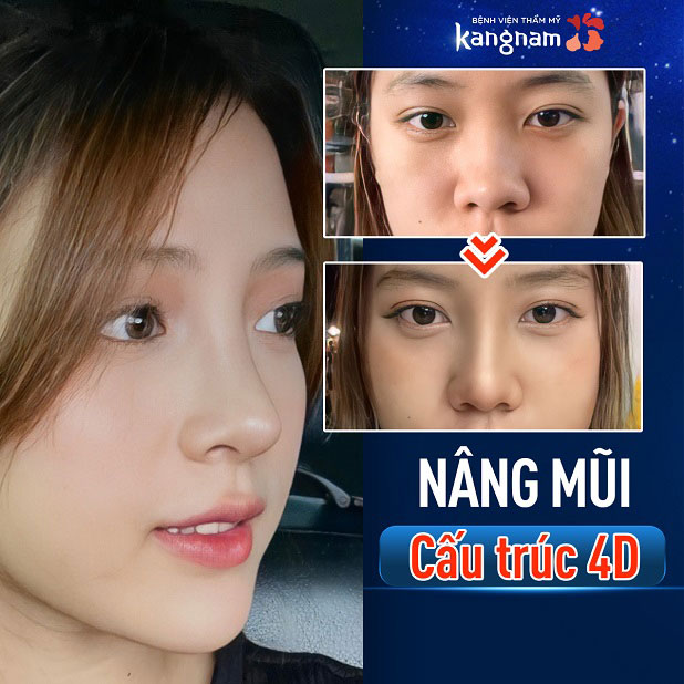 Dáng mũi thay đổi hoàn toàn sau khi nâng mũi cấu trúc 4D