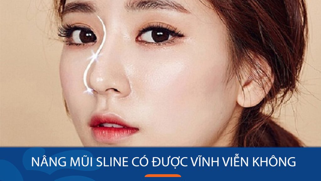 Nâng mũi Sline có được vĩnh viễn không? Tối đa bao lâu?