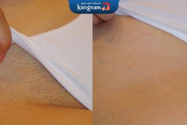 Kangnam bảo đảm sử dụng kỹ thuật triệt lông hiện đại