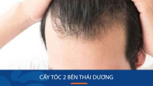 Cấy tóc 2 bên thái dương – Giải pháp thay đổi ngoại hình cấp tốc