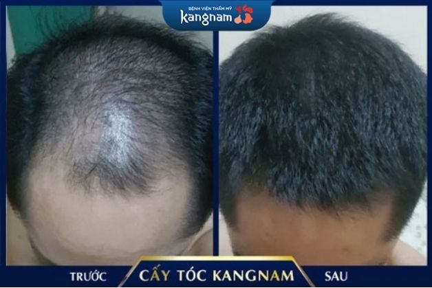 Cấy tóc 2 bên thái dương hiệu quả tại Kangnam