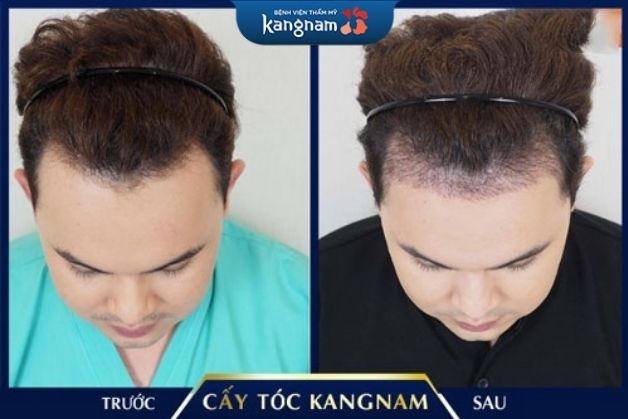 Cấy tóc an toàn, vĩnh viễn tại Kangnam