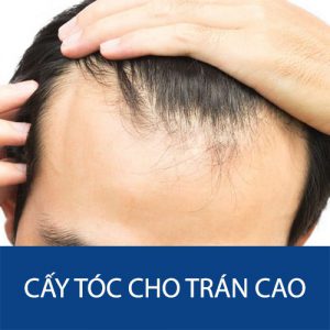 Cấy tóc cho trán cao: Bí quyết ‘xóa sổ’ hói – dô chỉ sau 1 lần chữa