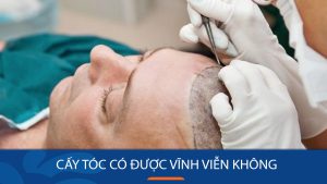 Cấy tóc có được vĩnh viễn không? – Sự thật cần biết