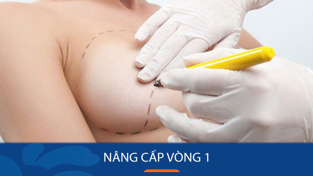 Nâng cấp vòng 1 như thế nào? Trường hợp nào cần thực hiện