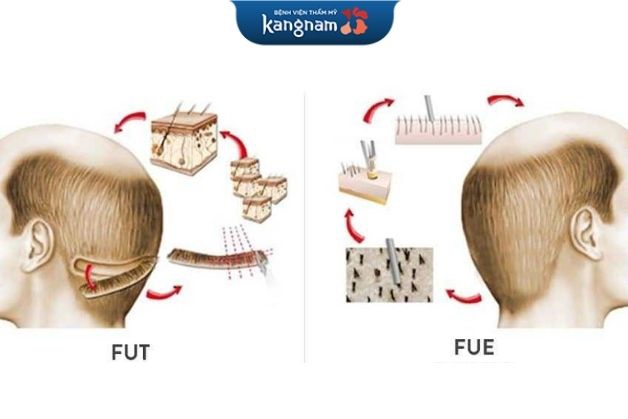 Phương pháp cấy tóc tự thân FUT vs. FUE