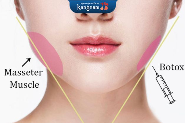 Tiêm botox gọn hàm có bị hóp má không?