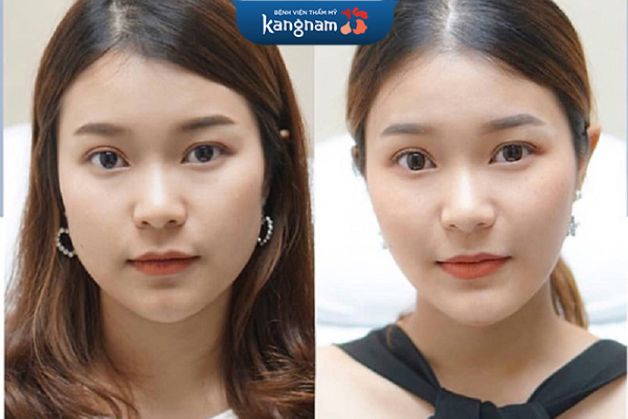 Tiêm botox gọn hàm bao lâu có tác dụng