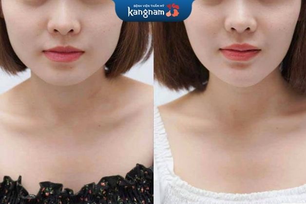Tiêm botox gọn hàm tại Kangnam