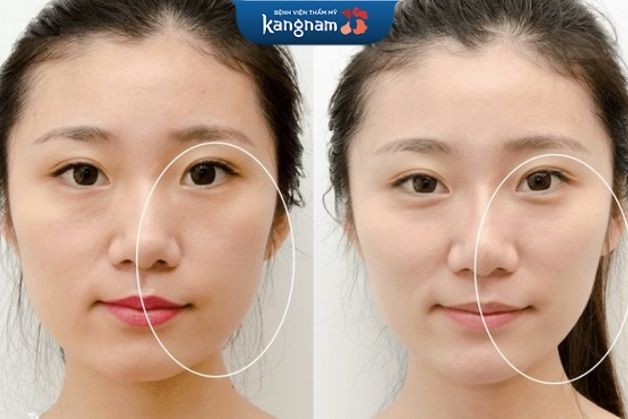 Tiêm botox khắc phục mặt lệch nhẹ