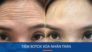 Tiêm botox xóa nhăn trán: Giải đáp thắc mắc về an toàn, liều lượng