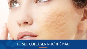 Trị sẹo collagen có thực sự hiệu quả? Chuyên gia giải đáp