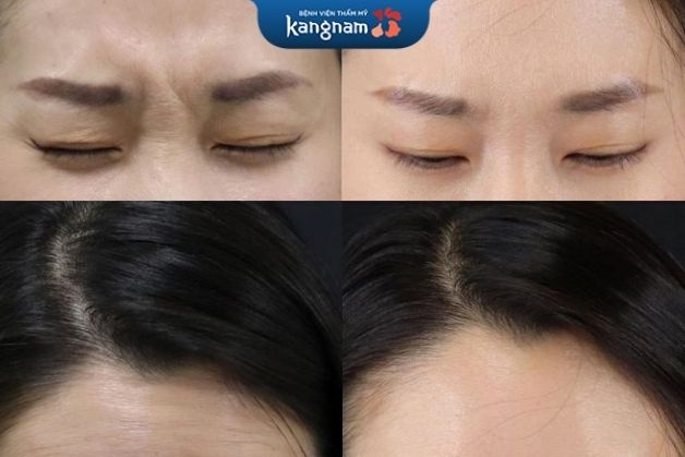 Xóa nếp nhăn trán bằng botox tại Kangnam