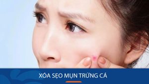 Xóa sẹo mụn trứng cá vĩnh viễn: Bí quyết nào hiệu quả?