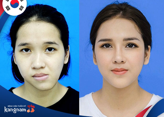Gương mặt chị Trang đã cân đối và đẹp hơn sau khi chỉnh hàm lệch